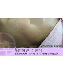 치료 후