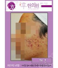 치료 전
