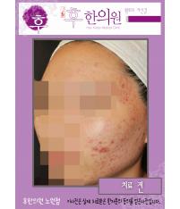 치료 전
