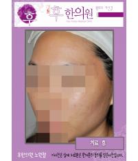 치료 후