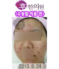 치료 전