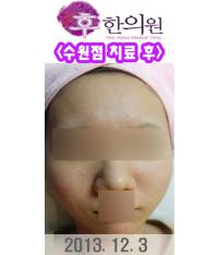 치료 후
