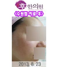 치료 후