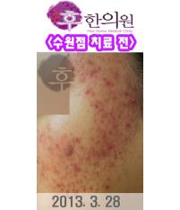치료 전