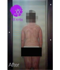 치료 후