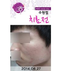 치료 후