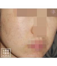 치료 후