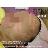 치료 전