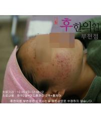 치료 전