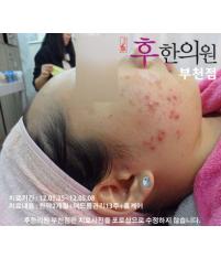 치료 전