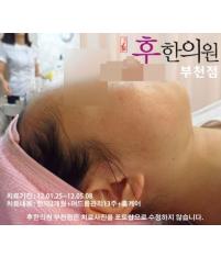치료 후