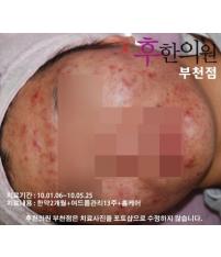 치료 전