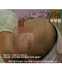 치료 전