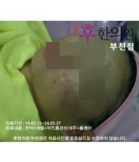 치료 후