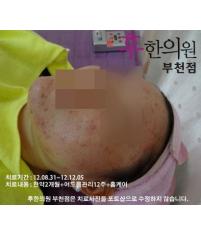 치료 전