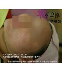 치료 후