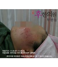 치료 전