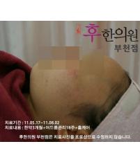 치료 후