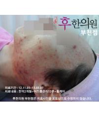 치료 전