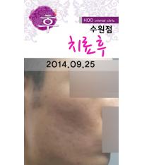 치료 후