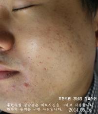 치료 전