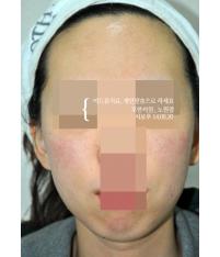 치료 후