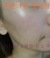 치료 후
