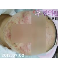 치료 전