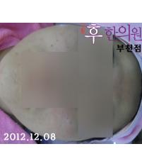 치료 후