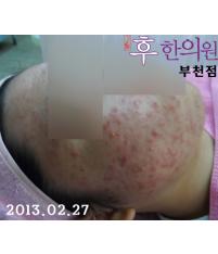 치료 전