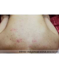 치료 전