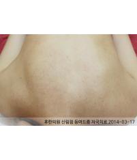 치료 후