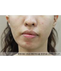 치료 후