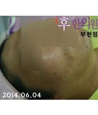 치료 후