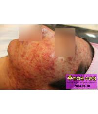 치료 전