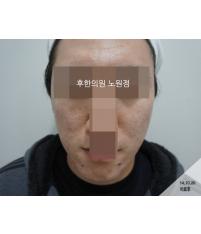 치료 후