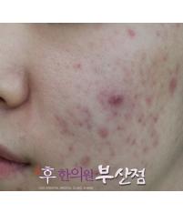 치료 전