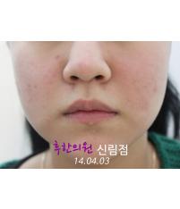 치료 후
