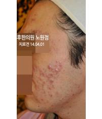 치료 전