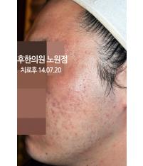치료 후