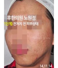 치료 전