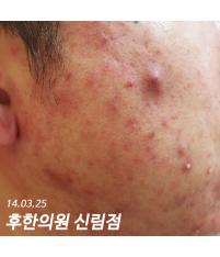 치료 전