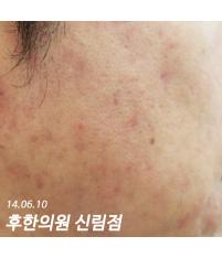 치료 후