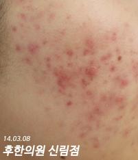 치료 전