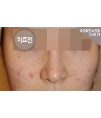 치료 전