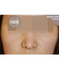 치료 후