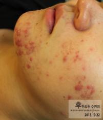 치료 전
