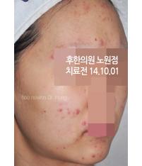 치료 전