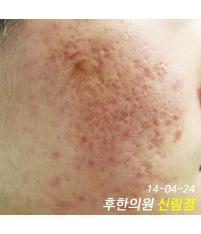 치료 전