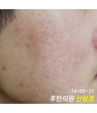 치료 후